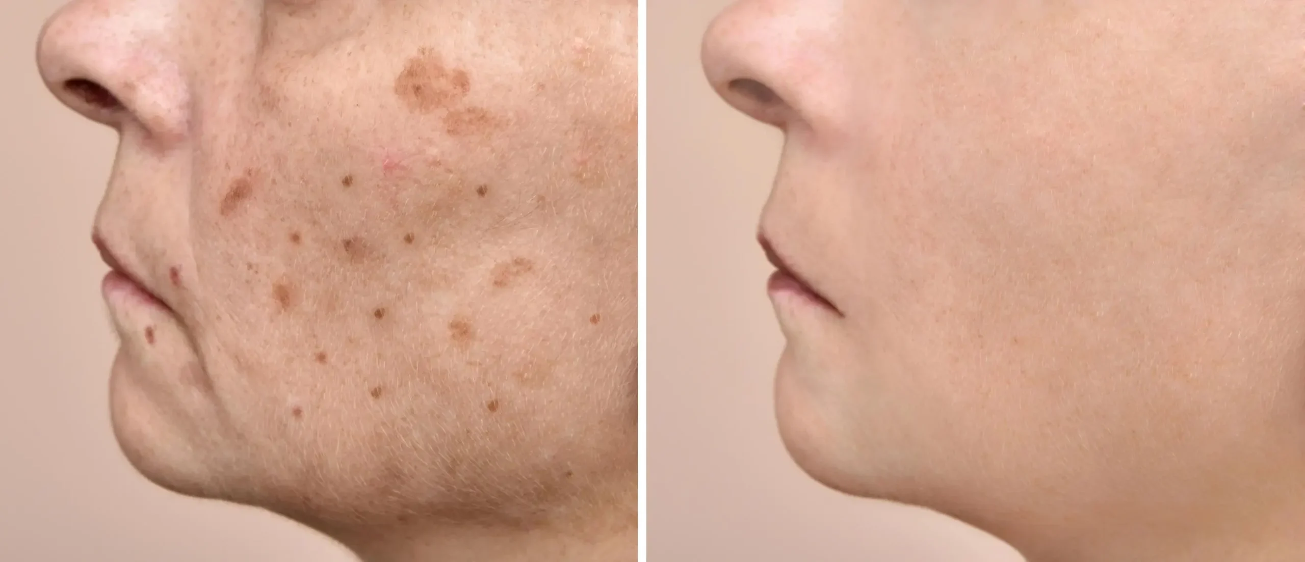 Jugos para eliminar manchas en la cara - Qué debo tomar para quitar las manchas de la cara jugos para eliminar manchas en la cara - Qué debo tomar para quitar las manchas de la cara